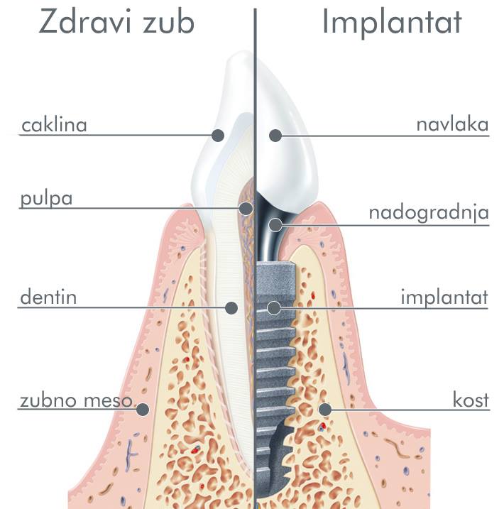 Implantati