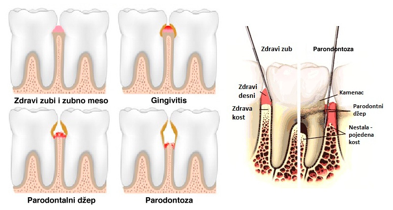 Parodontoza